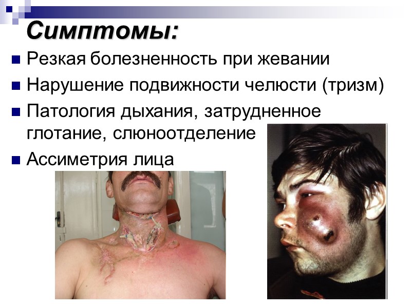 Симптомы: Резкая болезненность при жевании Нарушение подвижности челюсти (тризм) Патология дыхания, затрудненное глотание, слюноотделение